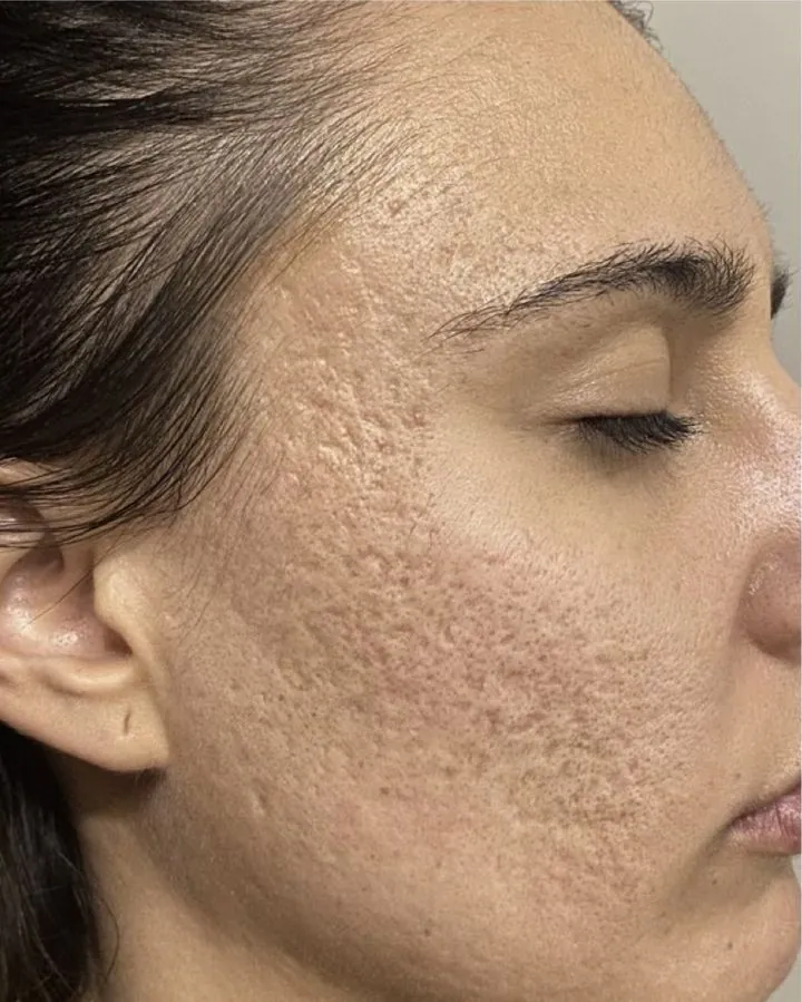 Cicatriz de acne, antes